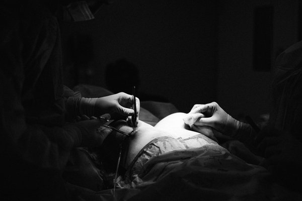 Augmentation mammaire à marseille : redonnez confiance à votre silhouette